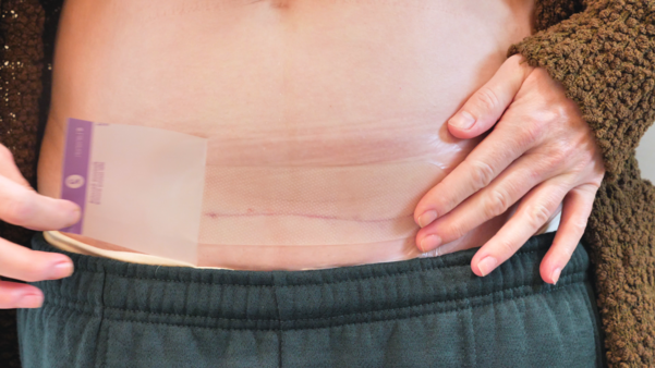 Clinical Evaluation of a novel hydrogel dressing for protection of Caesarean Section Incisions under expected use conditions.